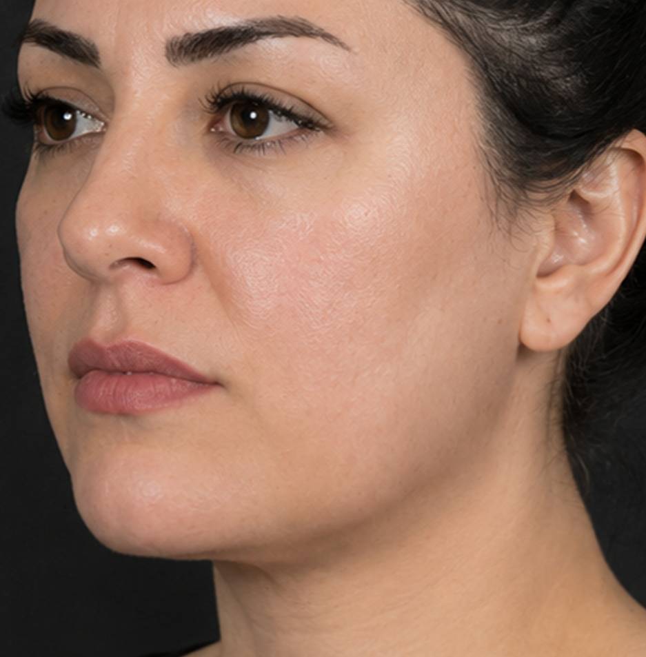 بعد از اندوتایت — نمونه ۳
