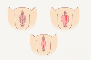 لابیاپلاستی جراحی زیبائی واژن