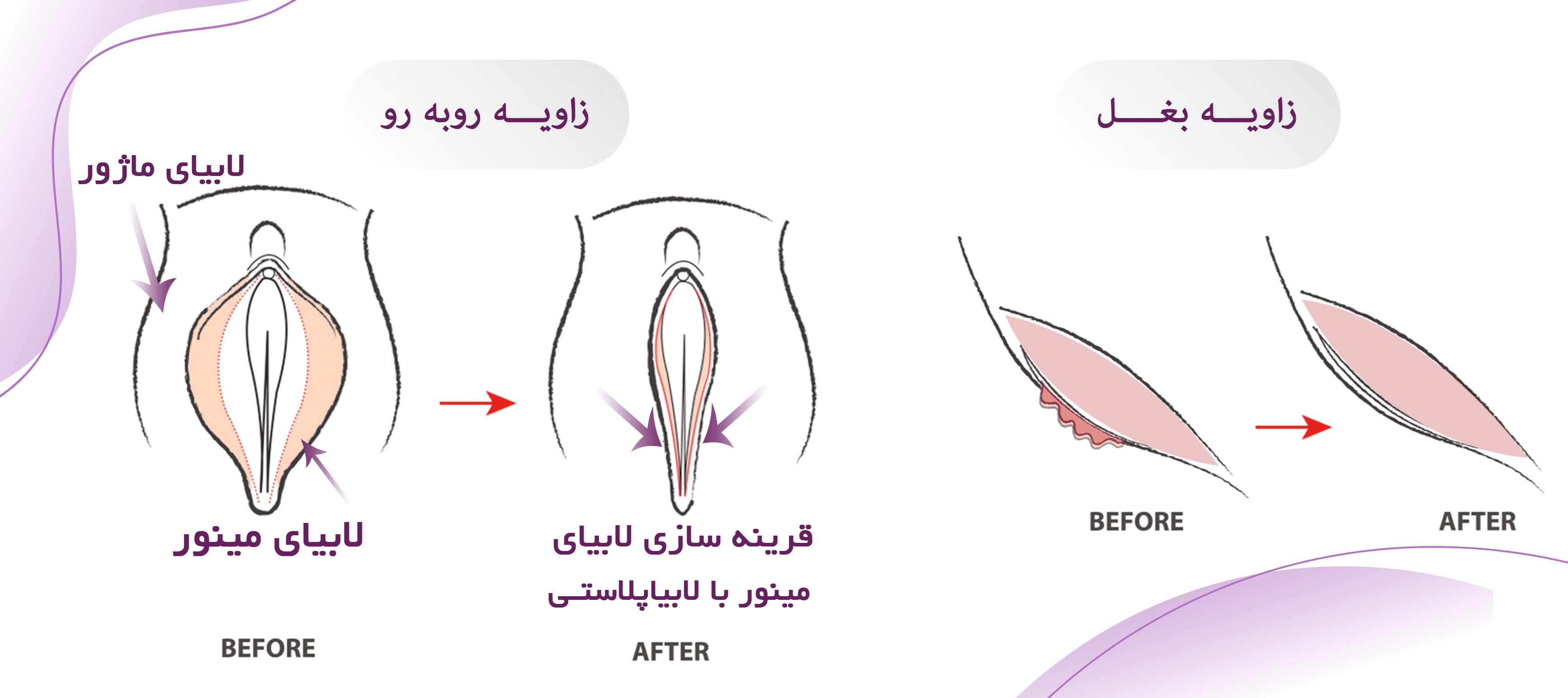 روش Seculped Linear