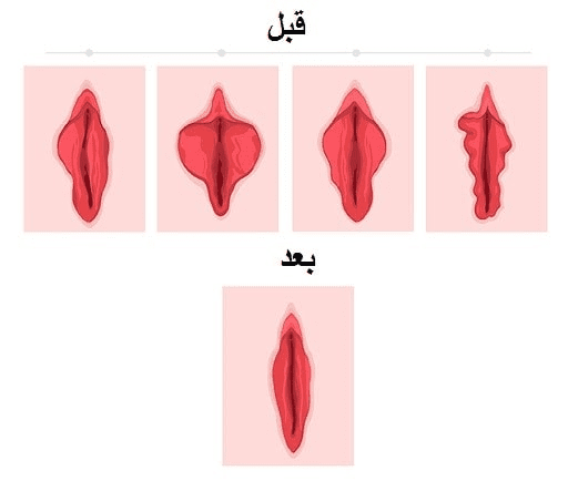 عمل لابیاپلاستی برای دختر باکره