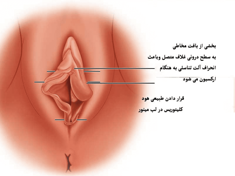 لابیامینورپلاستی