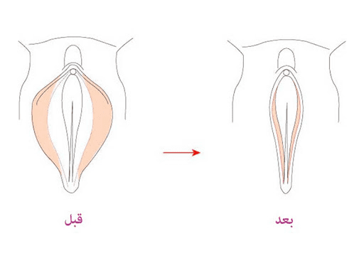لابیاپلاستی