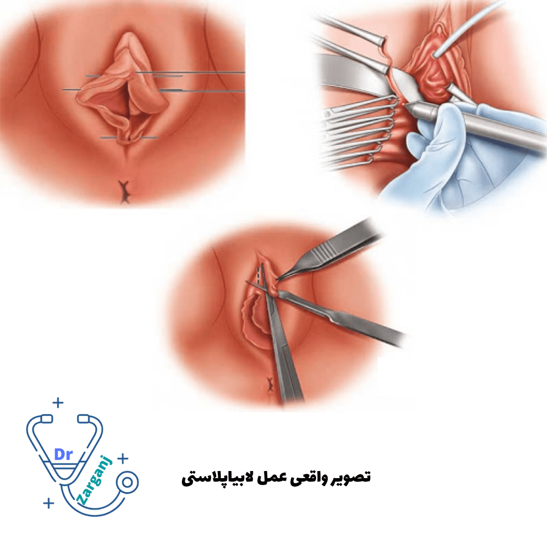 عکس قبل و بعد لابیاپلاستی