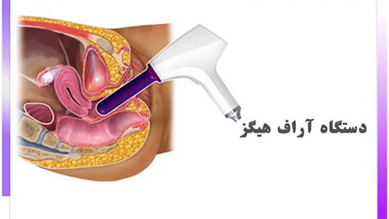 مزایای دستگاه هیگز در چیست؟