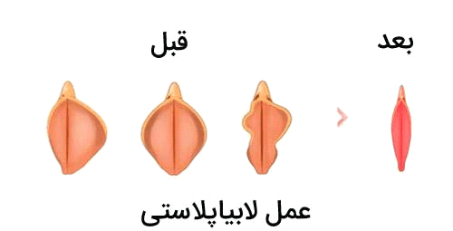 علت سوزش بعد از عمل لابیا