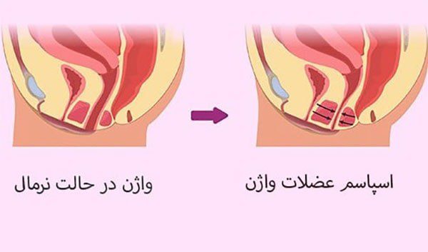 خطر تأخیر درمان واژینیسموس