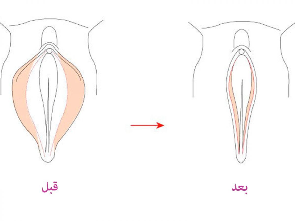 لابیا مینور یا لابیا داخلی: