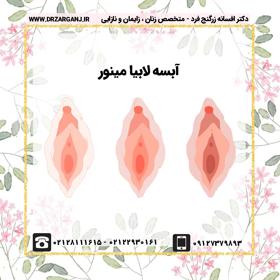 آبسه لابیا مینور | 7 نکته مهم که احتمالا نمی دانید ✔️