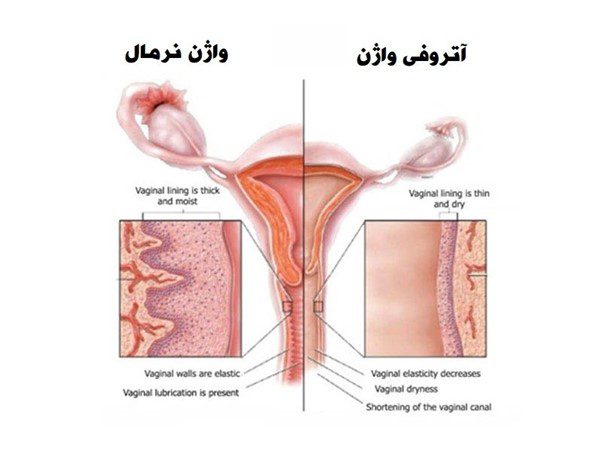 علت نازک شدن پوست اطراف واژن