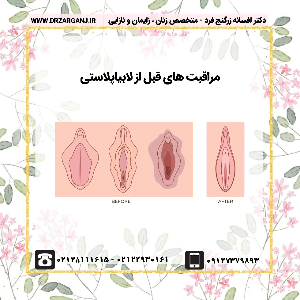 مراقبت های قبل از لابیاپلاستی