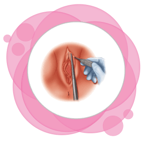 هودکتومی جراحی زیبایی کلیتوریس